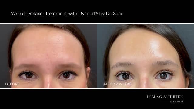 Botox before and after results — Dysport wrinkle treatment by Dr. Saad Hinsdale IL